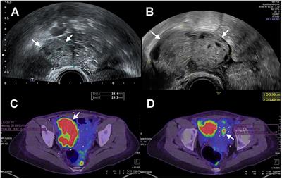 Progression of fertility-sparing treatment for atypical endometrial hyperplasia in a woman with lynch syndrome: a case report and review of the literature